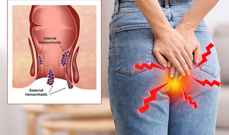 fistula